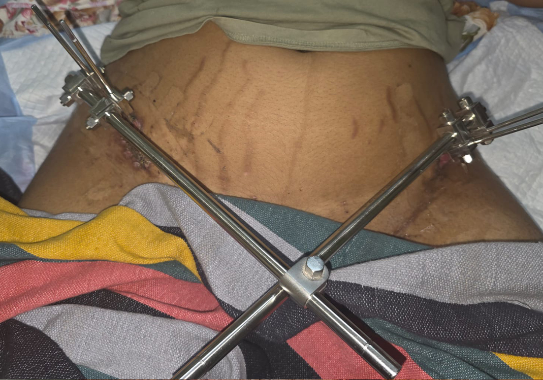 21-Year-Old Ayesha Is Fighting To Walk Again