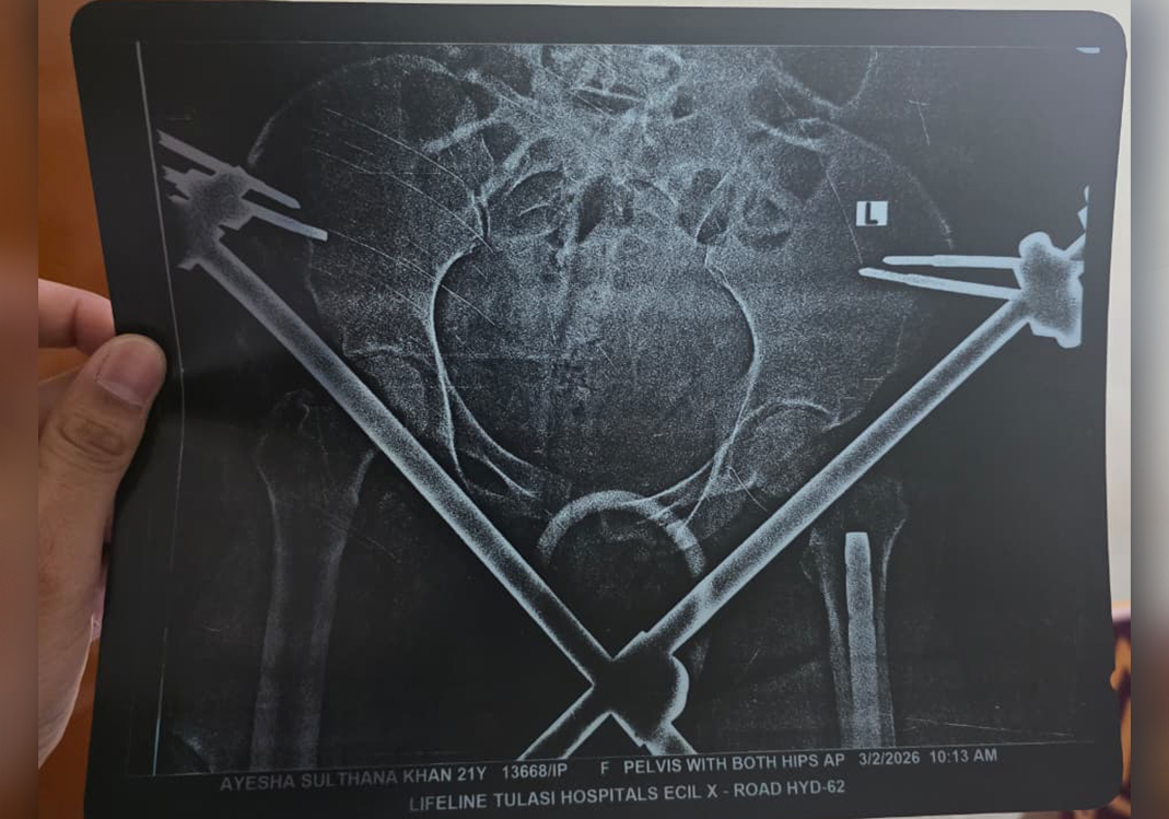 21-Year-Old Ayesha Is Fighting To Walk Again