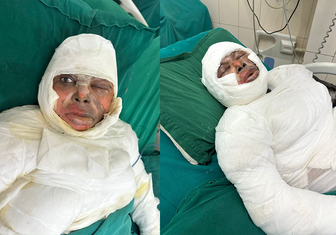 From Tragedy to Hope: Help Popi Kalita Fight for Her Life
